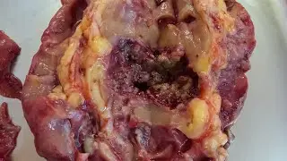 PCNL перкутанная нефролитотрипсия @Dr.urolog