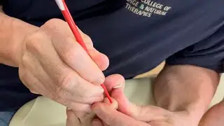 Deep foot reflexology Raynor massage using chopsticks. Part 3 of Brandon Raynor working on Brooke.