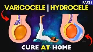 Cure Varicocele & Hydrocele at home with Yoga #varicocele #hydrocele #cure #yoga