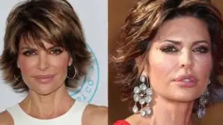 Lip Fillers vs. Lip Implants - Surgeon Minute