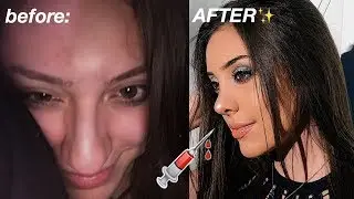 my nose job experience at 18 || recovery, before and after!