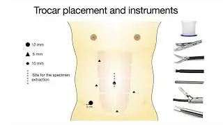 The role of accessory middle colic artery in D3 lymph nodes dissection for splenic flexure cancer