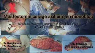 Mastectomie Curage axillaire en monobloc / mastectomy with Axillary lymph node dissection (ALND)