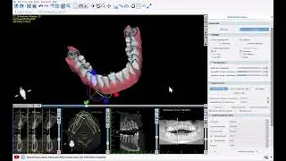 BSP V4.13: Aligner Digital Tooth Setup and Teeth Movement Controls with True Anatomical Movement
