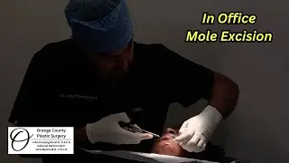 In Office Mole Excision | Orange County Plastic Surgery #plasticsurgeon #plasticsurgeryresults