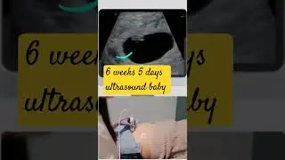 Baby | 6 weeks  5 days | ultrasound scan #baby #pregnancy #infant #shorts