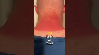 Don’t try this at home #sunburn  #sunscreen #bald