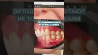 Нарушение смыкания зубов 