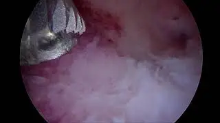 Polipectomía Histeroscópica con Bigatti Shaver