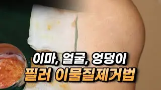 이마, 얼굴, 엉덩이 등 필러 이물질 제거하는 방법!