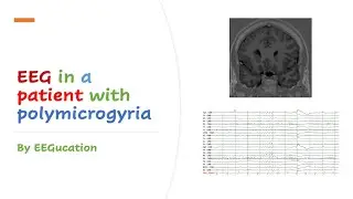 EEG in a Patient with Polymicrogyria