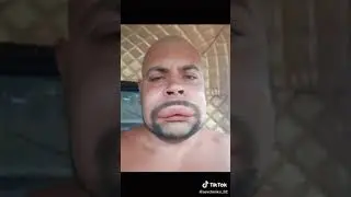 укус шершня