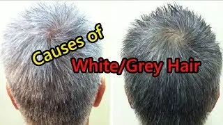 What Causes White Hair at Early Age in 20s