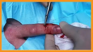 Will You Suture My Finger? | Auburn Medical Group