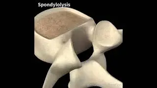 SPONDYLOLYSIS 🧽