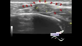 Pediatric soft tissues ultrasound - Subcutaneous lesion above the sternum