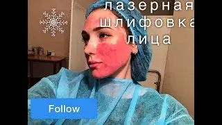 ФРАКЦИОННАЯ ЛАЗЕРНАЯ ШЛИФОВКА ЛИЦА