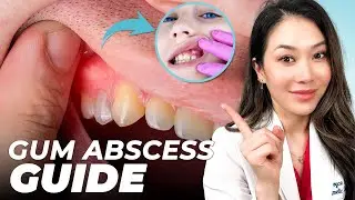 How to prevent and treat gum abscess