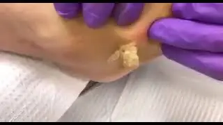 O QUE É ISSO? Será um CISTO GRANDE? 😱😨 - Vídeos Satisfatórios