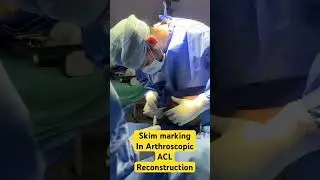 Skin marking in Arthroscopic ACL reconstruction #ligaments #injury #knee #keyhole #surgery