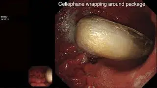 EXTRACTION OF DRUG PACKAGE FROM STOMACH