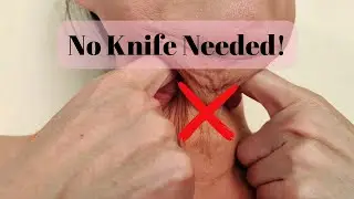 Eliminate Turkey Neck With or Without Surgery!
