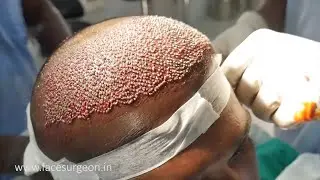 Step by Step FUE Hair Transplant Surgery in India