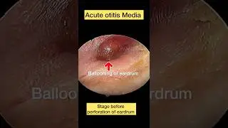 Acute otitis media | Ballooning of eardrum | Severe earache | Eardrum perforation
