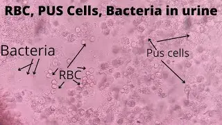 Pus cell | RBC | Bacteria under microscope | 