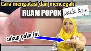 Cara mengatasi dan mencegah ruam popok pada bayi