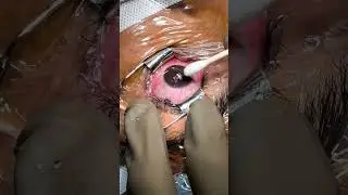 EPI Contoura Eye Treatment!!! 