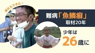 皮膚がウロコのように…難病「魚鱗癬」取材２０年　２６歳になった青年に彼女が