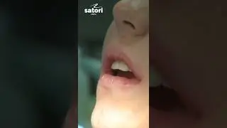 ФТОРИРОВАНИЕ ЗУБОВ