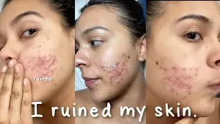 I Ruined My Skin with this Beauty Hack... 