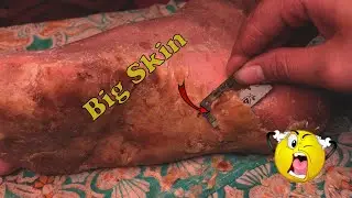 How to removal skin | callus removal skin flakes #42