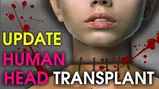 UPDATE : Will it be Successful?? First Human Head Transplant 2017  | Sergio Canavero (Frankenstein)