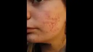 Accutane: Before and After