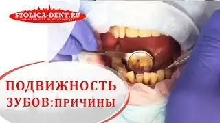 😬 Причины и способы устранения подвижности зубов. Подвижность зубов. Столица. 12+