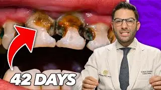 What happens if you NEVER brush your teeth? | Dr Daniel DDS