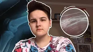 БЕСПЛАТНАЯ МЕДИЦИНА  или ПОЧЕМУ Я БОЛЬШЕ НЕ МОГУ ХОДИТЬ