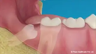 Surgical Tooth Extraction