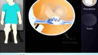 ACL Reconstruction With a Sterile Cadaver Graft