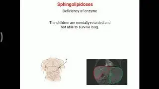 Sphigolipidoses
