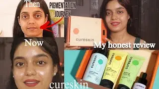 Skin journey with Cureskin || Honest review|| Pigmentation and Open Pores| real? or fake?
