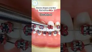 These Could Be Keeping You In Braces LONGER! 😭🦷