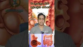 பெருங்குடலில் ஏற்படும் வீக்கம்|Diverticulitis treatment|Diverticulitis symptoms #diverticulitis #gut