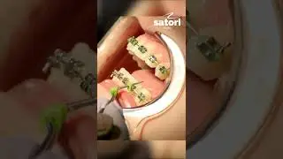 Снятие колечек на лигатурных брекетах 