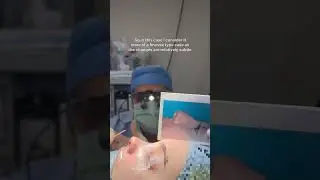 Immediate post-op rhinoplasty results | Anthony Bared MD, FACS | Miami, FL