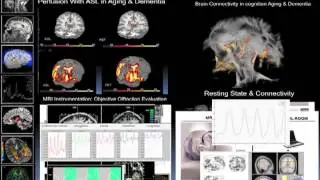 MRI Biomarkers in Alzheimer and Brain Diseases - Juan Antonio Hernandez