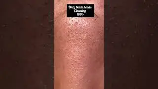 black heads removed with romever pin and strips